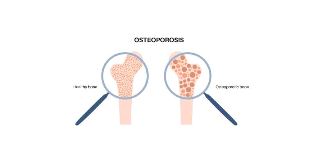Osteoporosis,Disease,Poster.,Systemic,Skeletal,Disorder,,Loss,Of,Bone,Mineral
